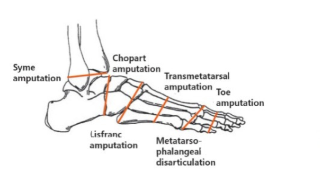 amputação de pé quais as causas