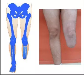 amputação transtibial